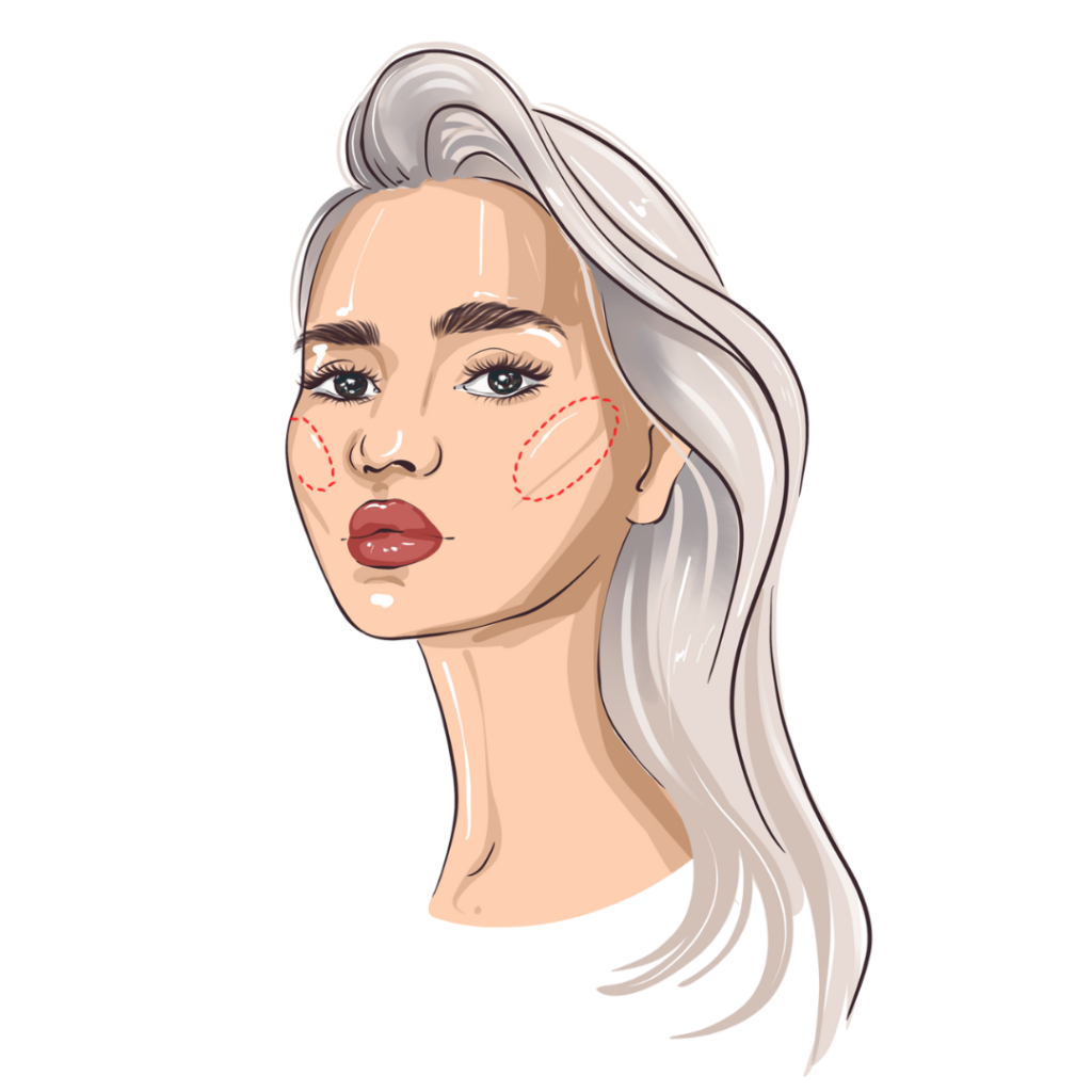 illustration-of-cheek-bone-lift-by-Skin-Perfect-Aesthetic-and-wellness